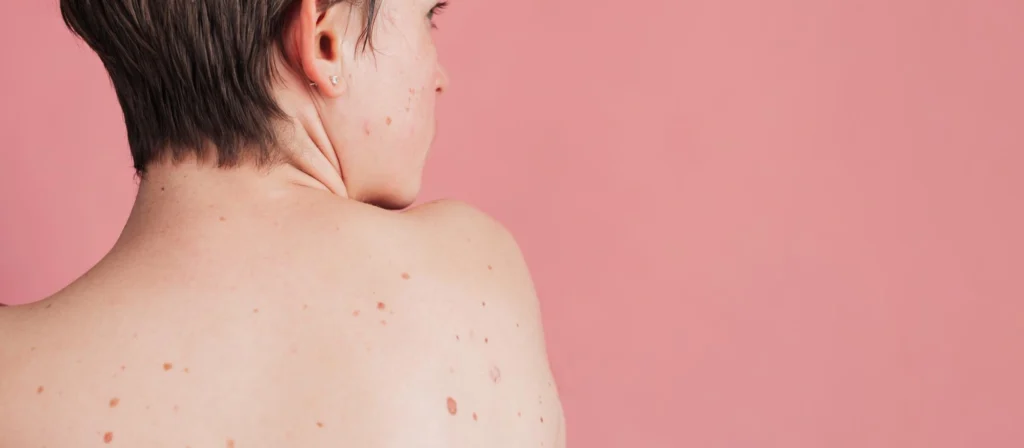 مراقبت‌های قبل از برداشتن خال