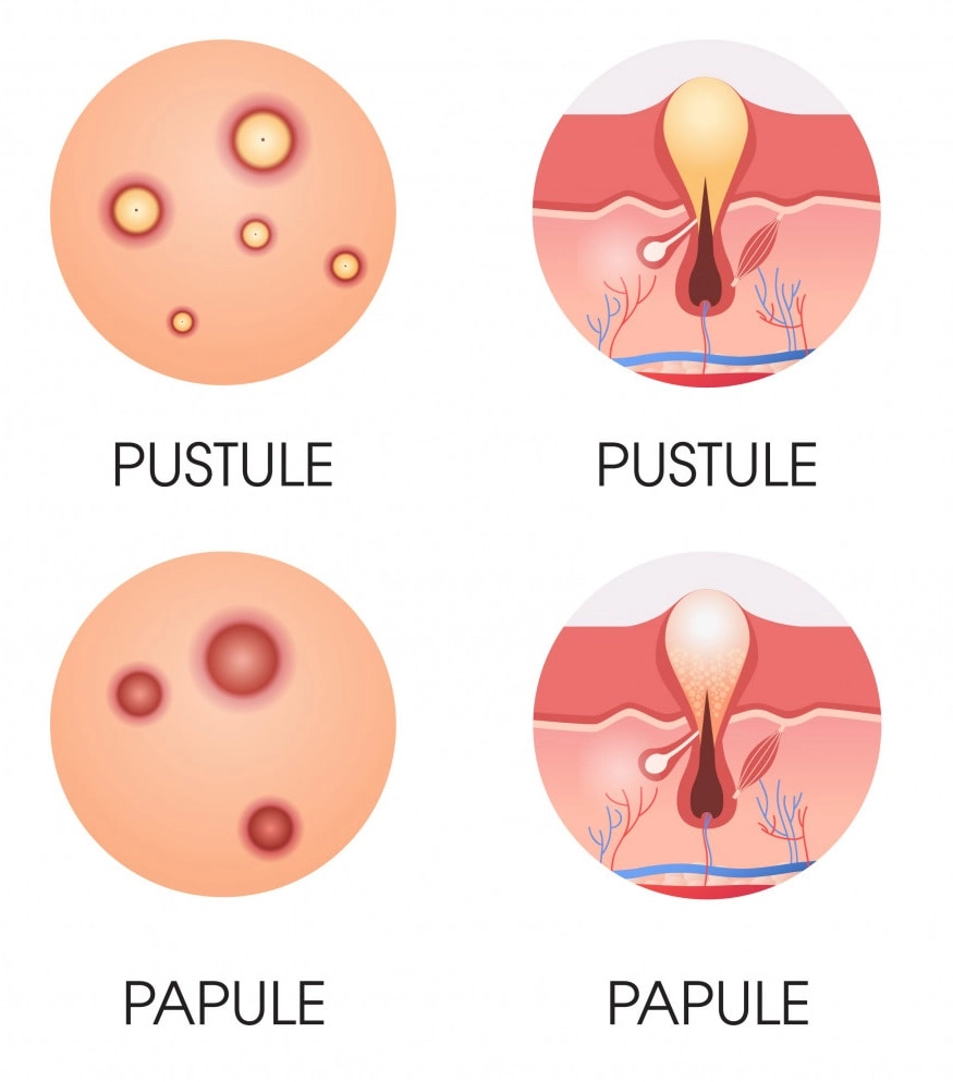 درمان جای جوش