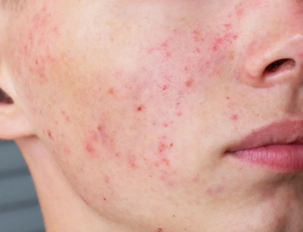 درمان جای جوش در کرج