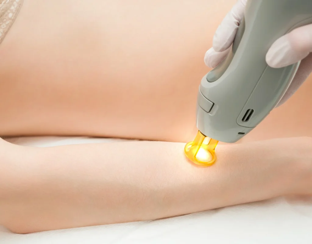 مراقبت‌های بعد از لیزر موهای زائد