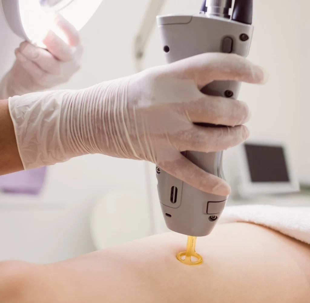 مراقبت‌های قبل از لیزر موهای زائد