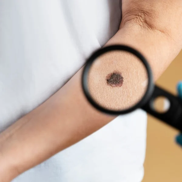 معایب برداشتن خال